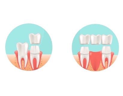 Как ухаживать за зубными протезами