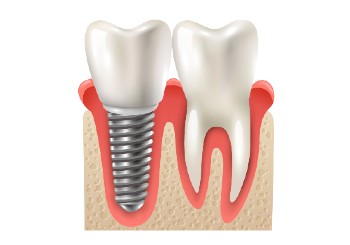 Временное протезирование на имплантатах