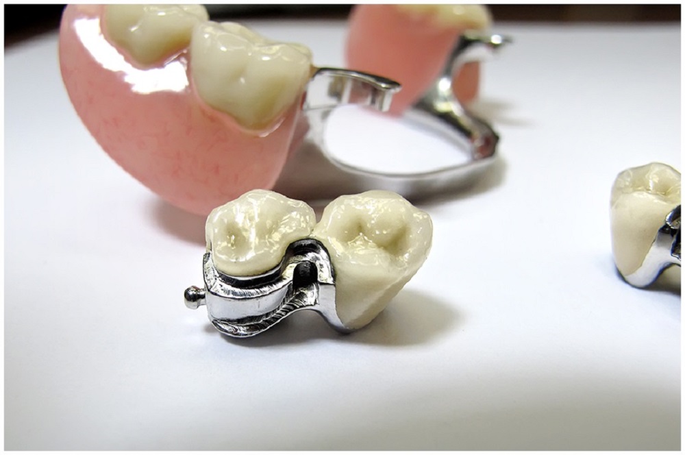 Замковые зубные протезы
