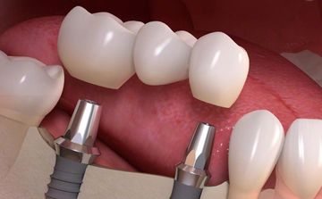 Зубные импланты из циркония