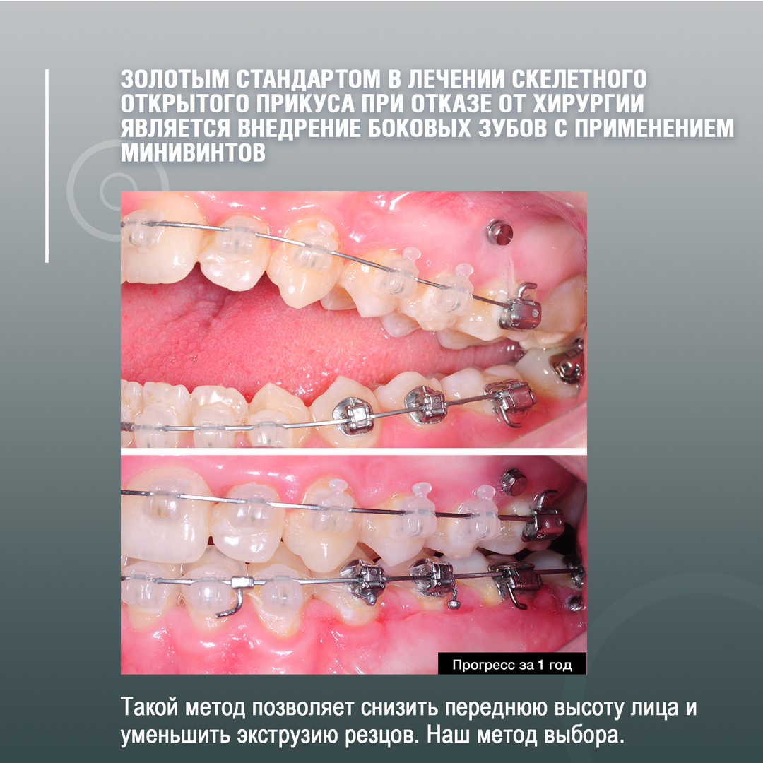 Внедрение боковых зубов с применением минивинтов