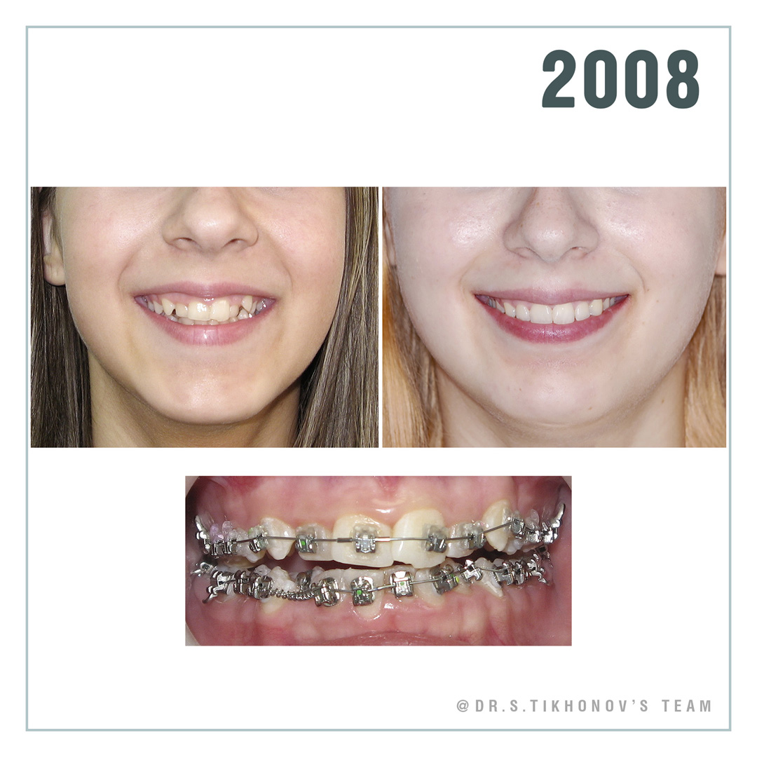 брекеты всегда надо ставить высоко