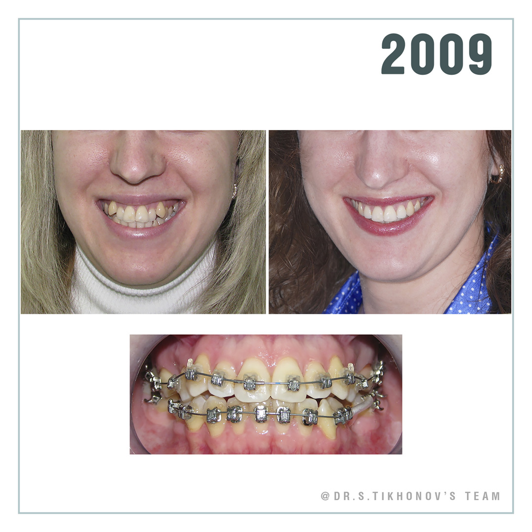 брекеты всегда надо ставить высоко
