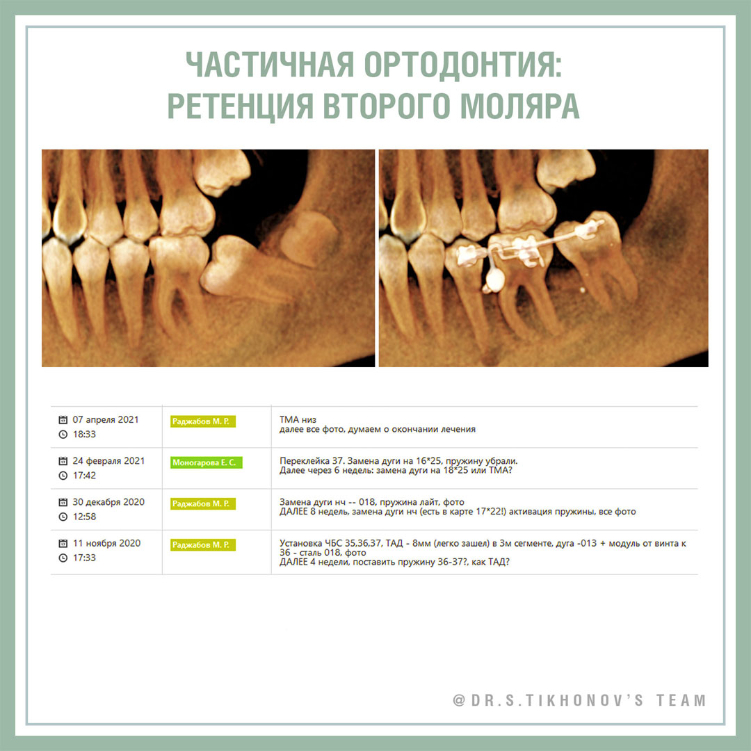 Частичная ортодонтия: ретенция второго моляра