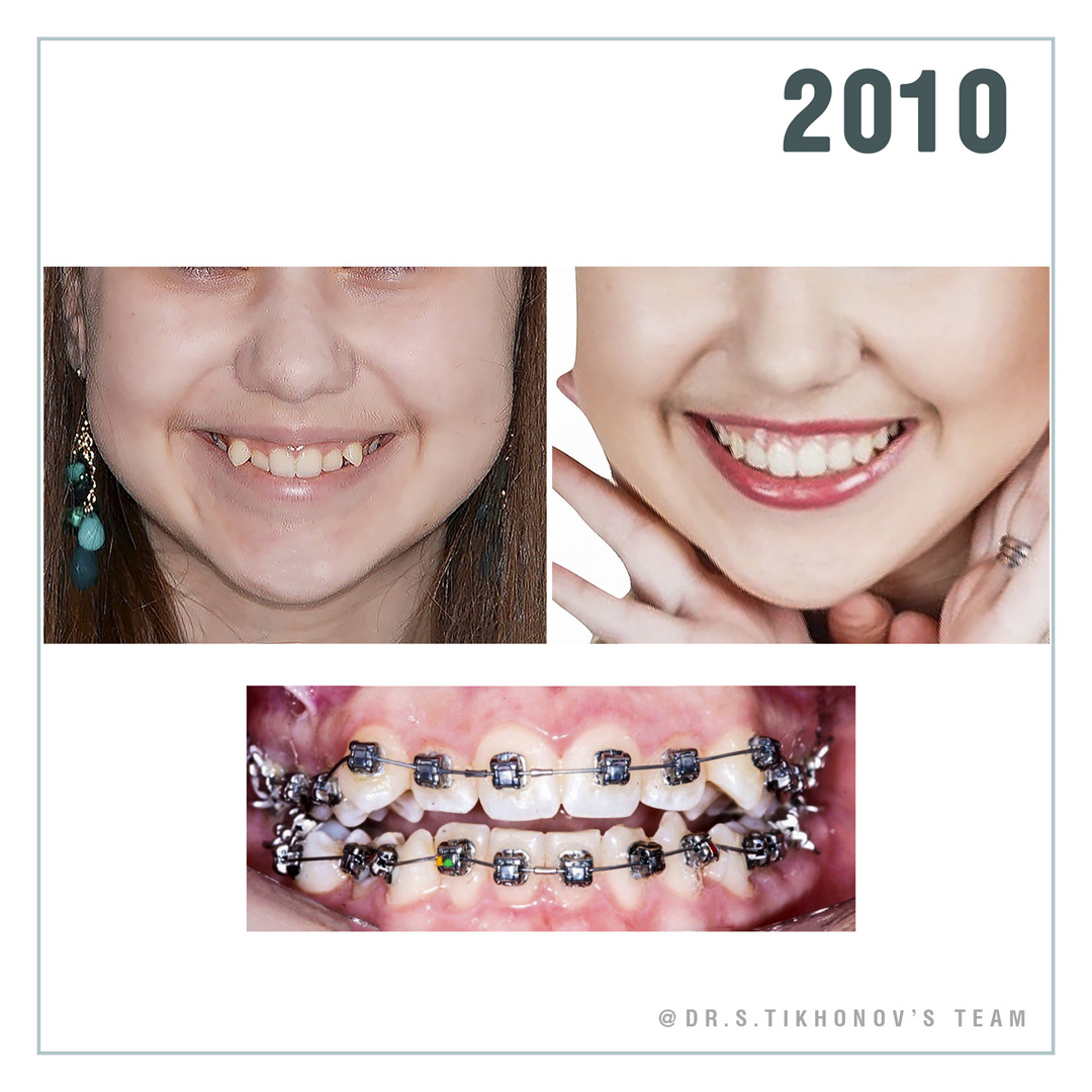 брекеты всегда надо ставить высоко