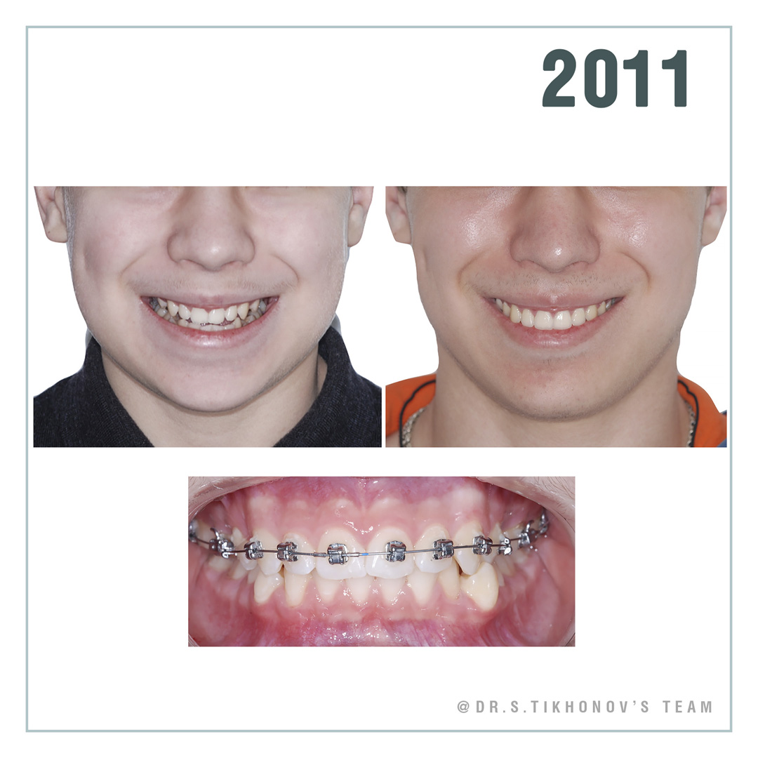 брекеты всегда надо ставить высоко