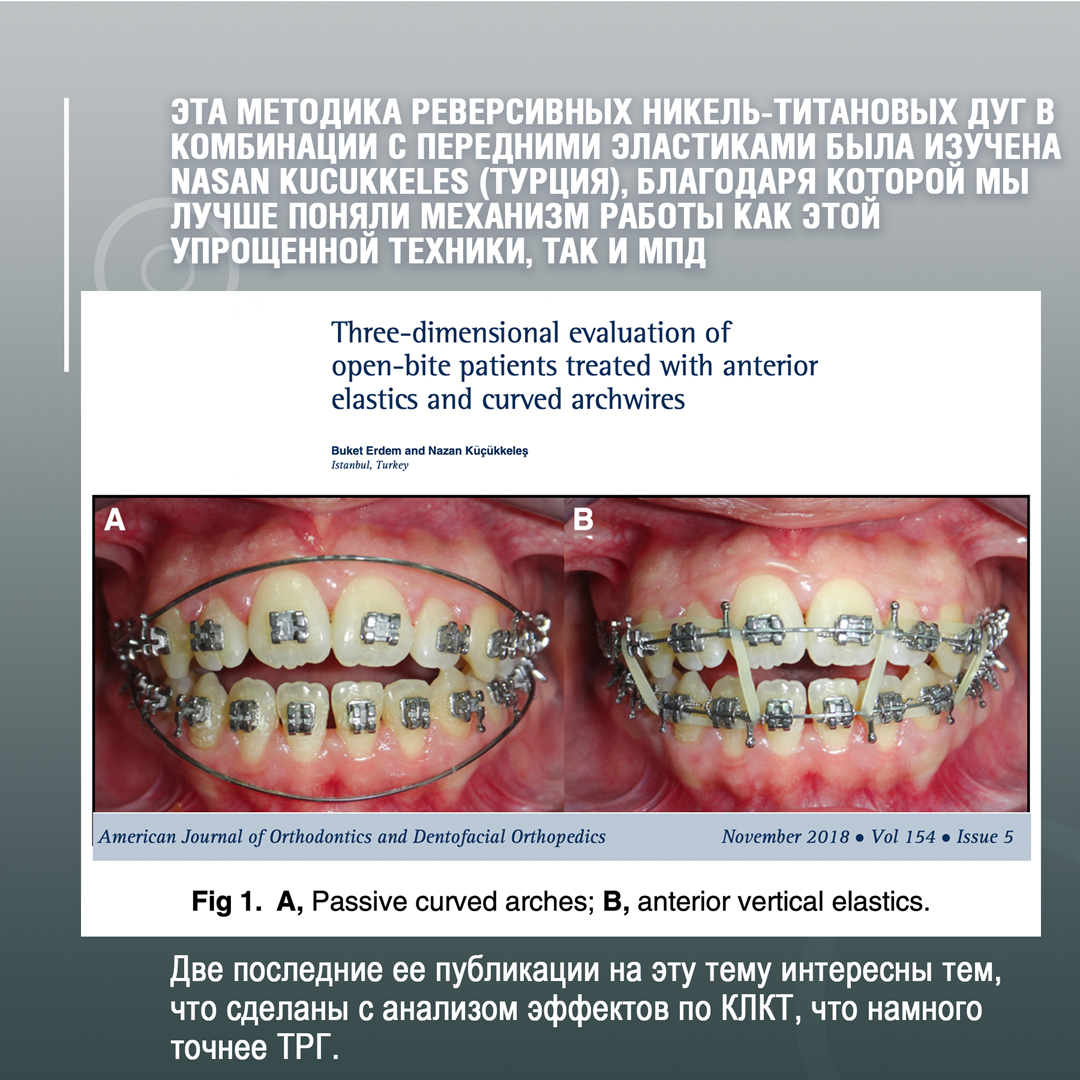 Методика реверсивных никель-титановых дуг
