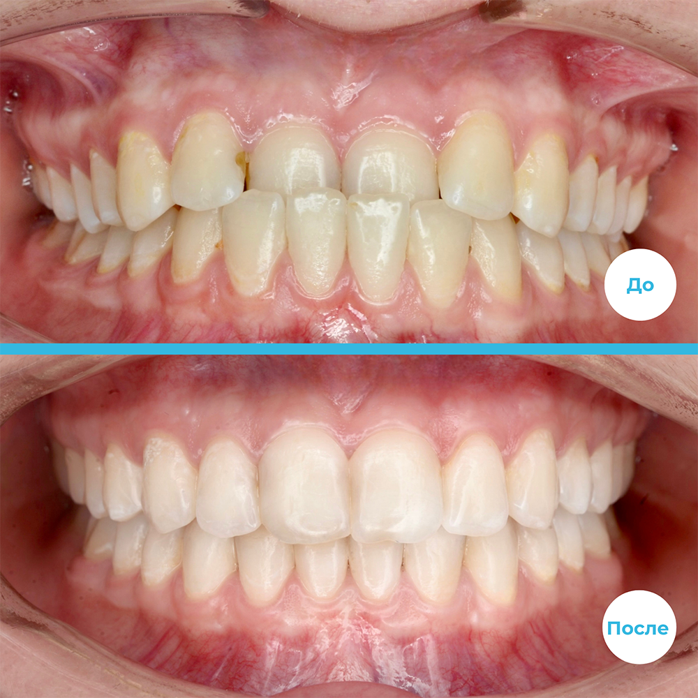 Лечение на элайнерах Spark