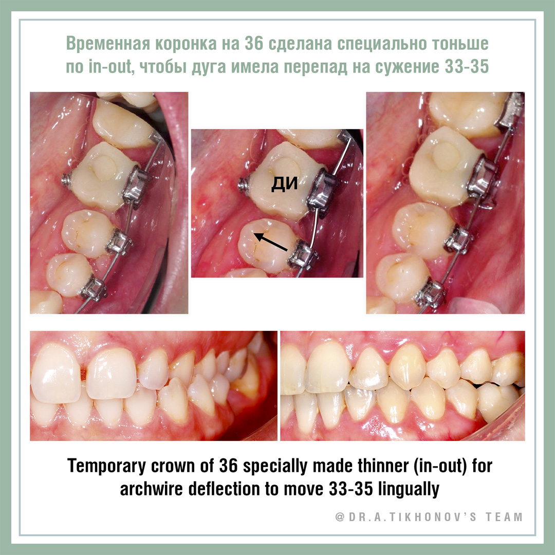 Временная коронка на 36 сделана специально тоньше по in-out, чтобы дуга имела перепад на сужение 33-35