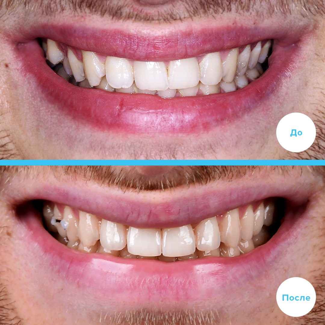 Ортодонтическое лечение, коррекция средней линии на верхней челюсти с удалением сверхкомлектного зуба