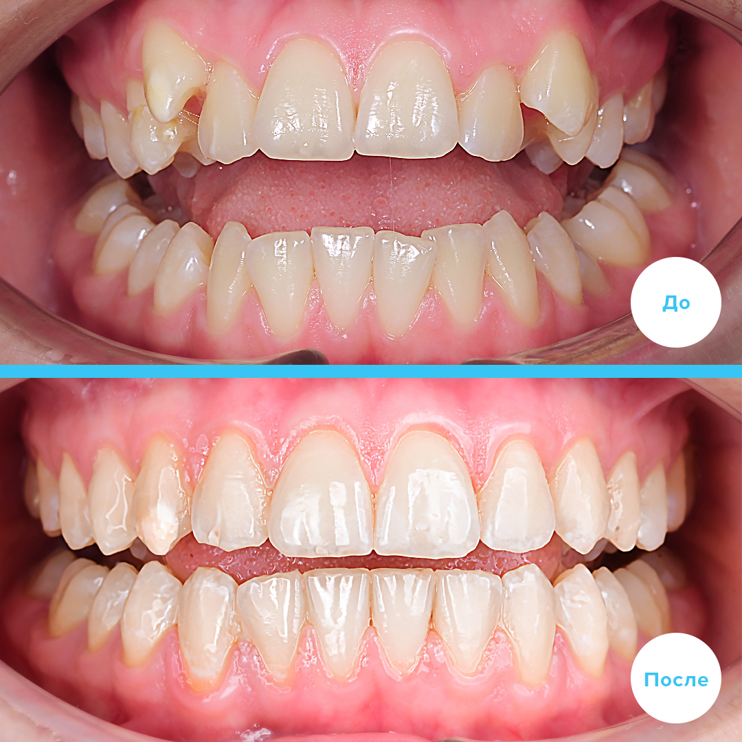 Сложный клинический случай лечение на элайнерах!