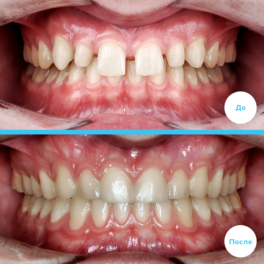 Damon Q на обеих челюстях 