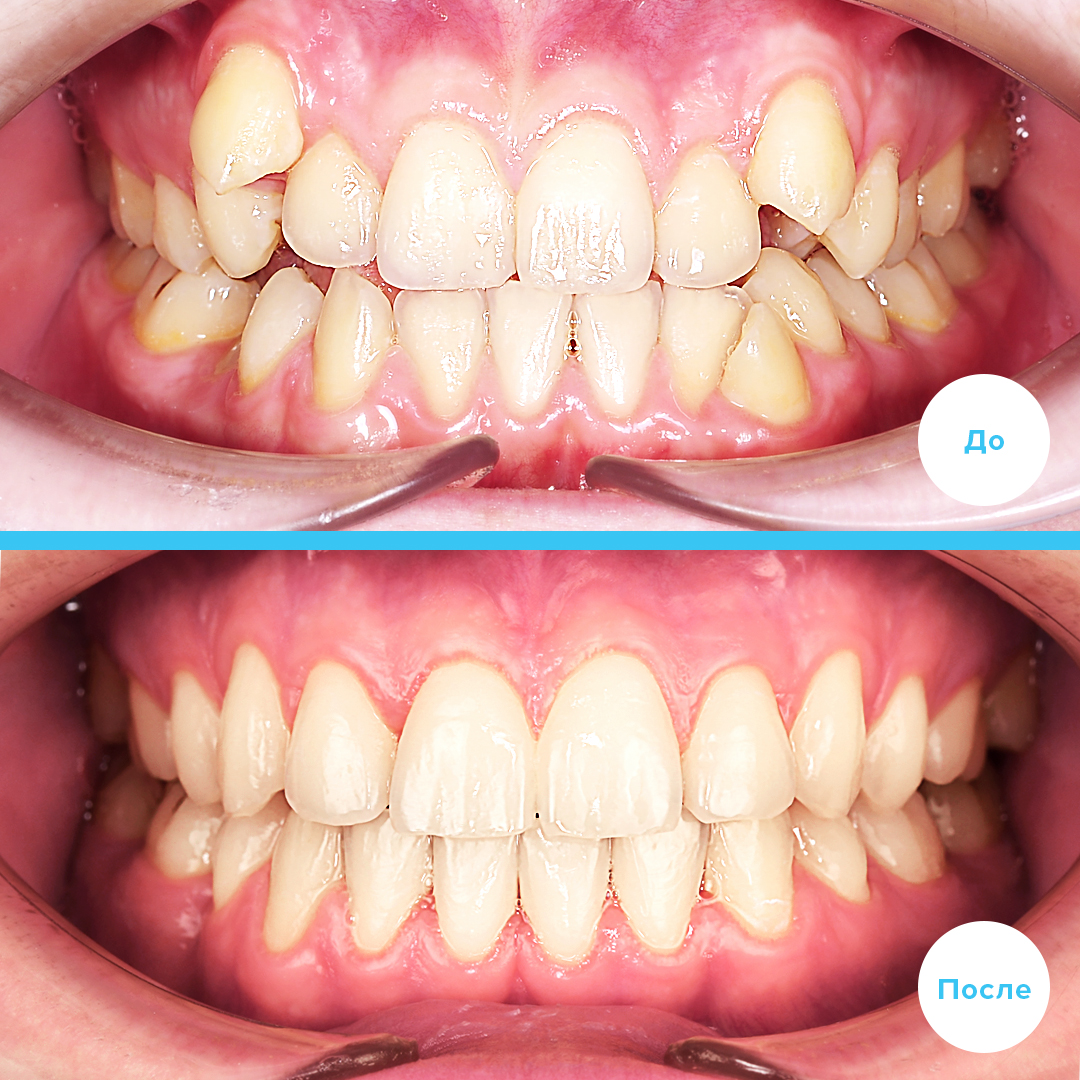 Лечение 3 класса с удалением 4х премоляров