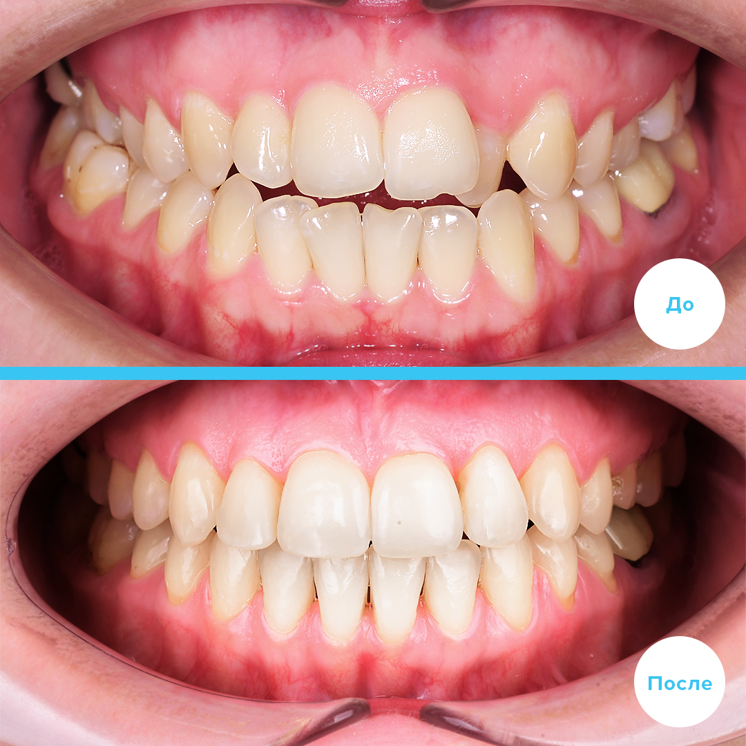 Проведена компенсация открытого прикуса