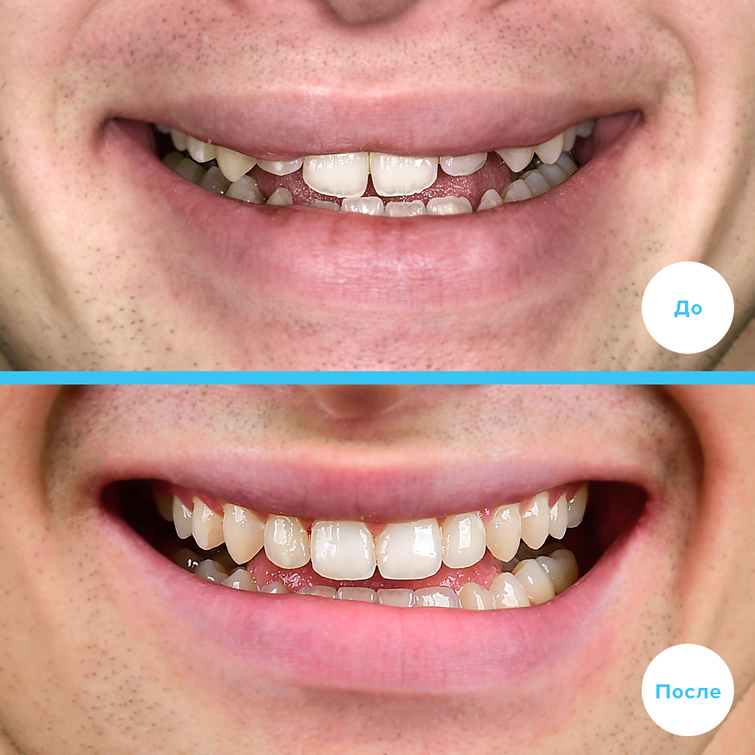 Лечение 3 класса. Устранено обратное перекрытие в переднем отделе