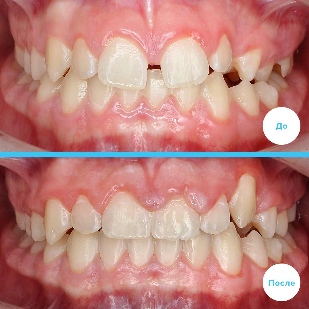 Смещение центра на верхней челюсти влево, ретенция зуба 2.3, диастема, сужение верхнего зубного ряда слева, перекрестный прикус слева