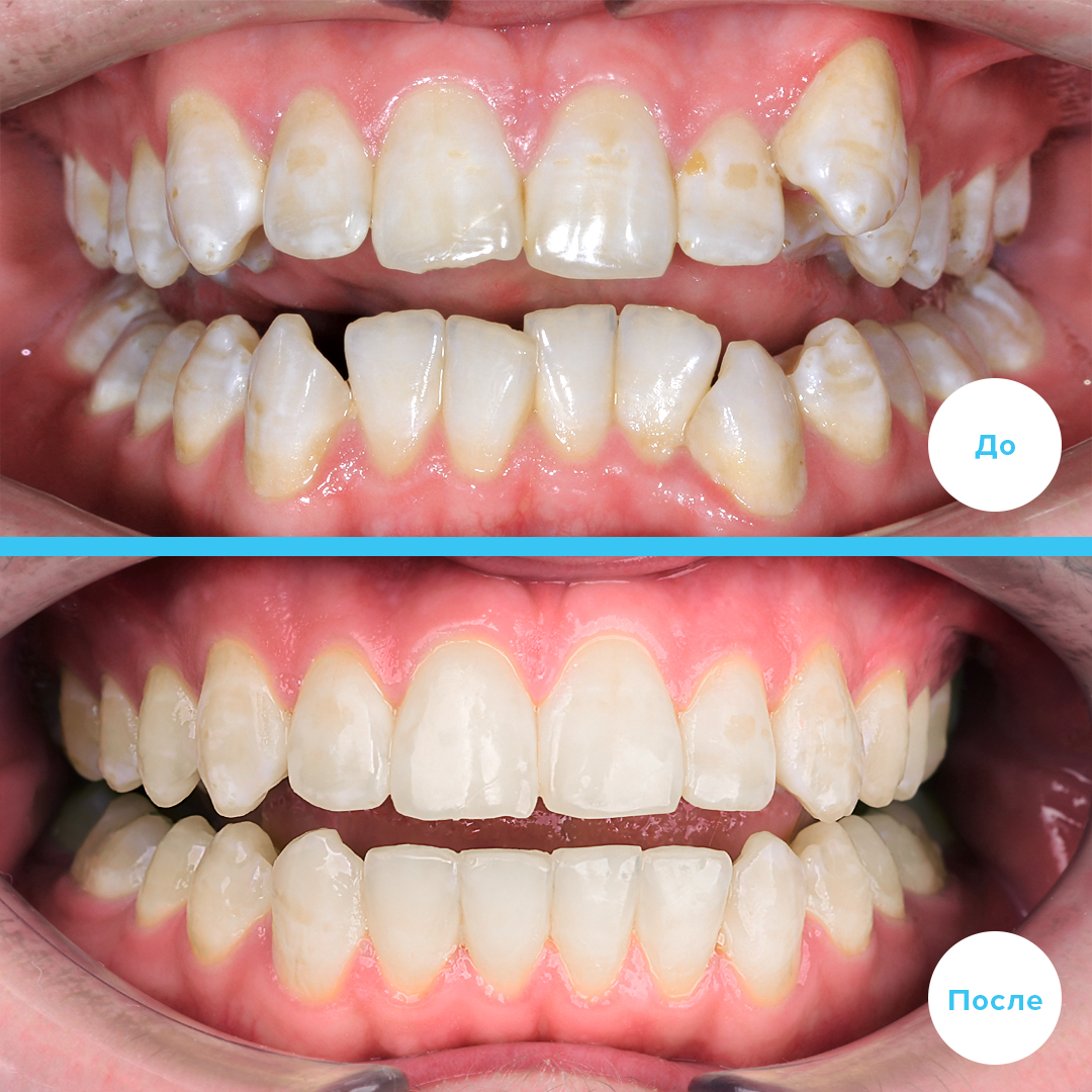 Проведено  лечение скученности зубов