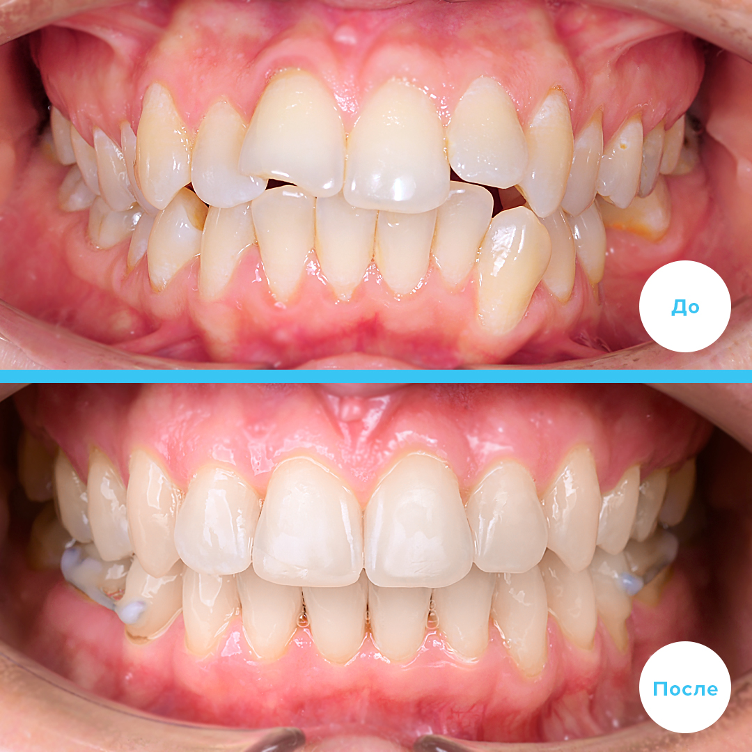 Лечение сложного клинического случая с удалением 3х премоляров и закрытием пространства от удаленного зуба 3.6 своими зубами без имплантации