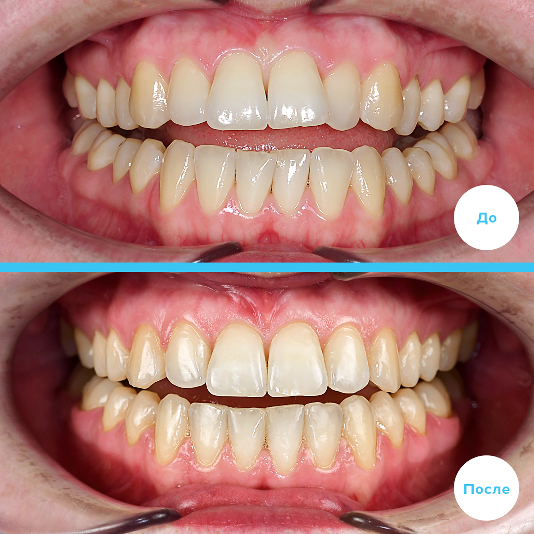 Проведено лечение перекрестного прикуса c использованием эластиков