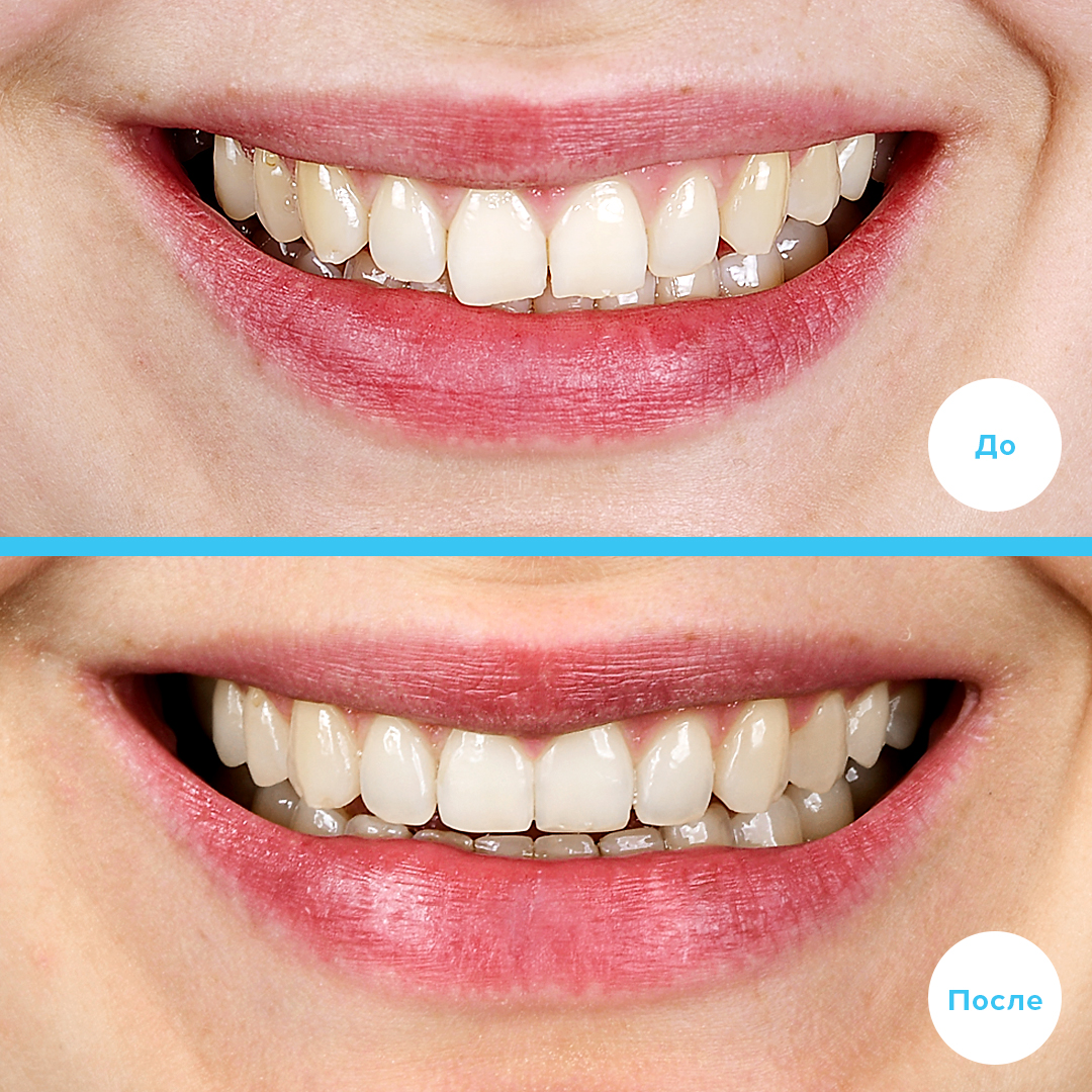 Лечение дистальной окклюзии