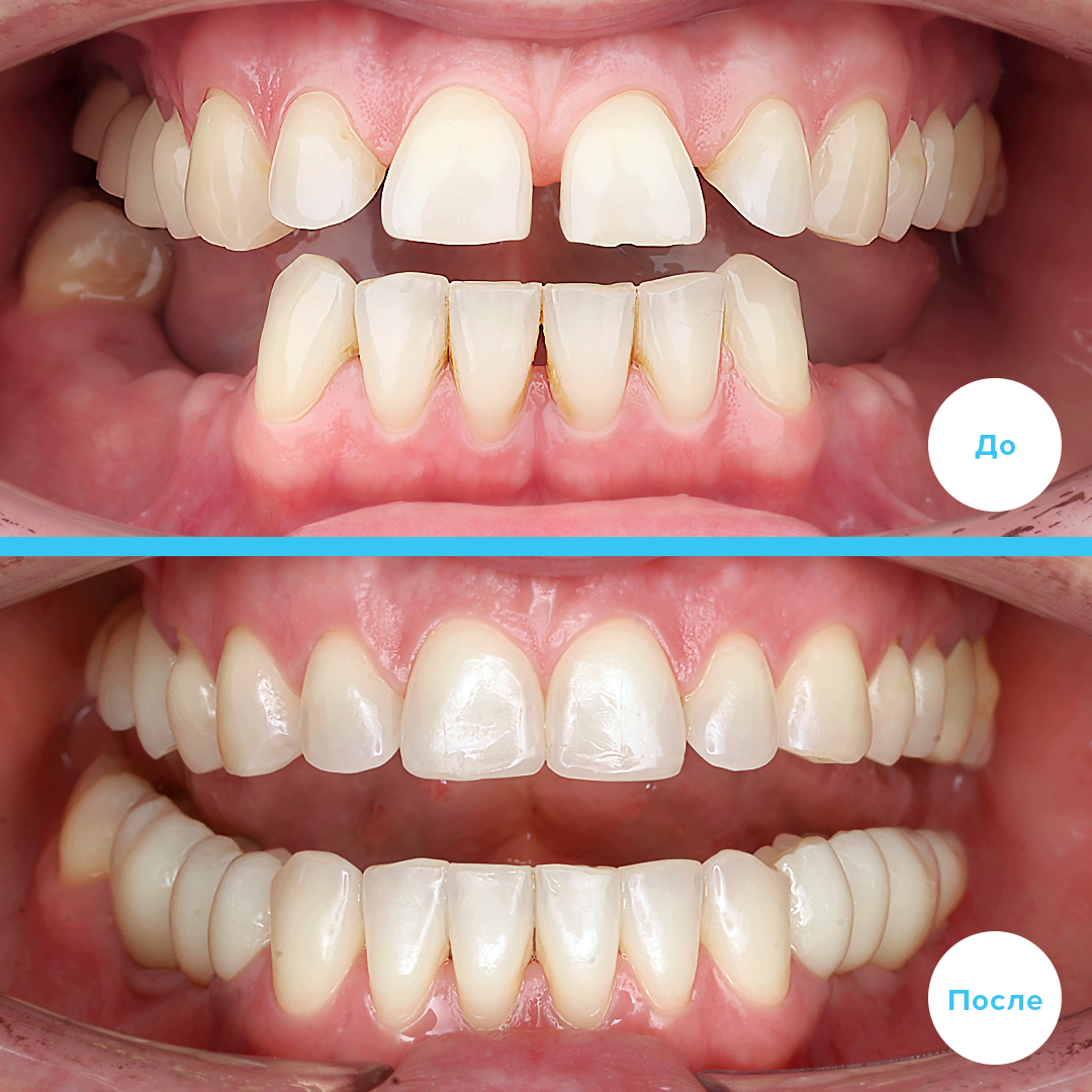 Брекет-система DQ2 на верхнюю и нижнюю челюсть 