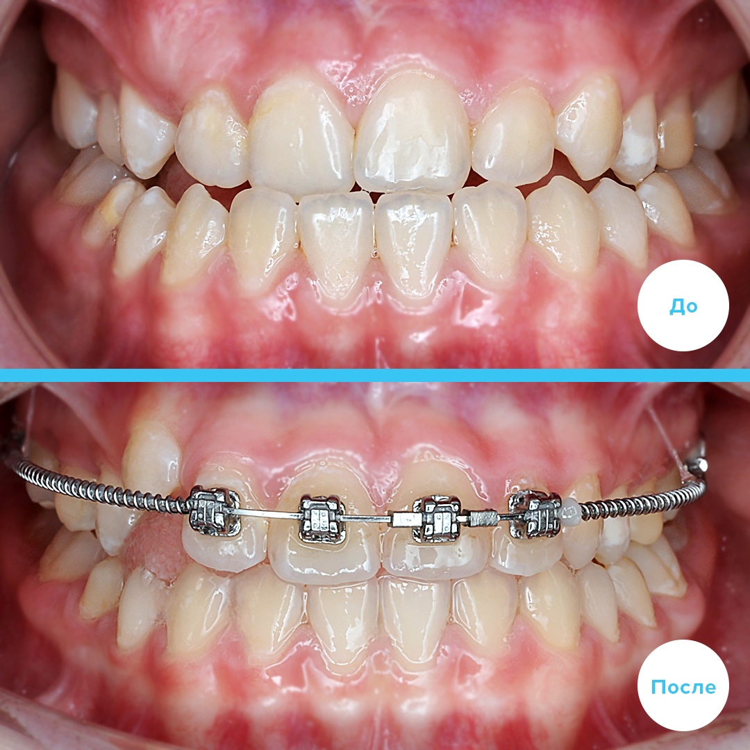 Мезиальный прикус с обратным перекрытием