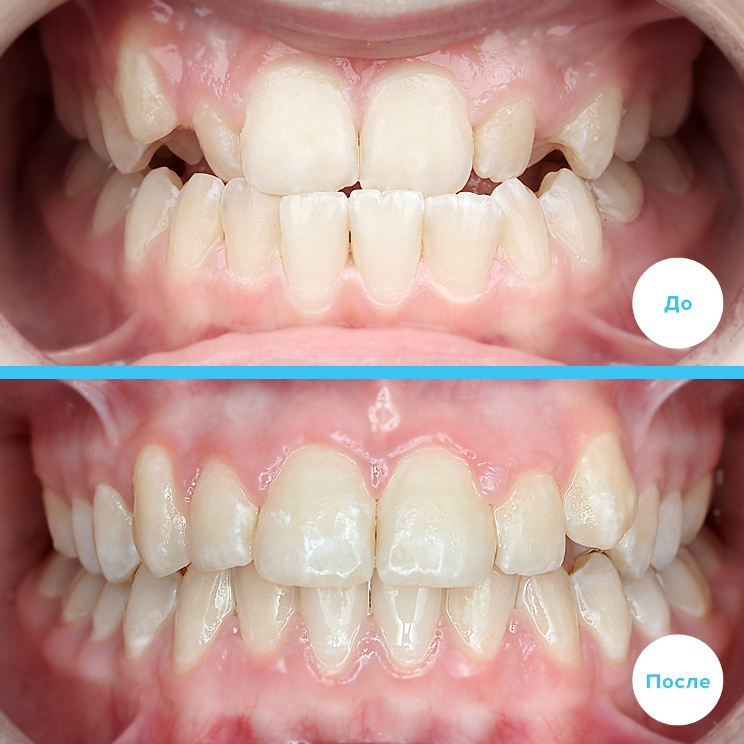 Лечение обратного перекрытия
