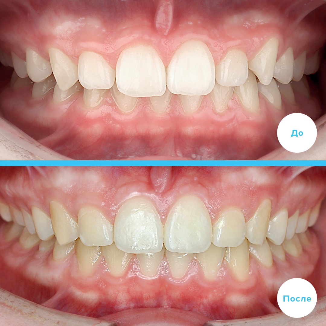 Глубокий прикус