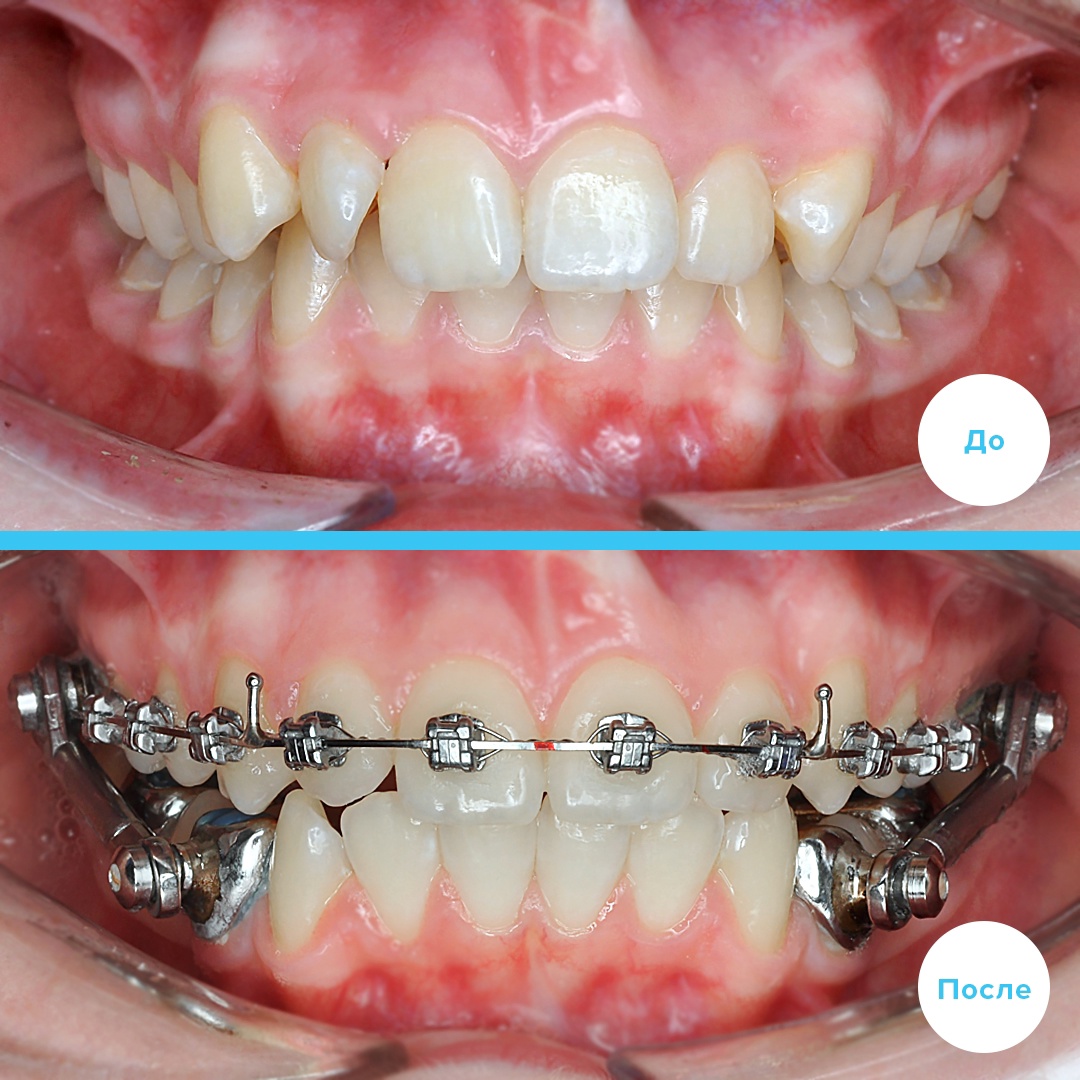 Ортодонтическое лечение подростка металлическими брекетами на 1 челюсти и аппаратом Гербста