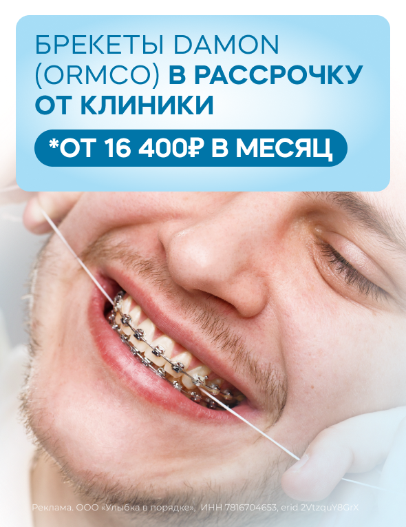 Рассрочка от клиники на брекеты — от 16400 рублей в месяц