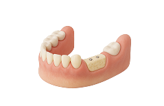 Реконструкция альвеолярного отростка