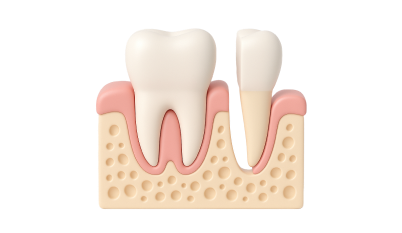 Реконструкция альвеолярного отростка