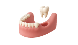 Реконструкция альвеолярного отростка
