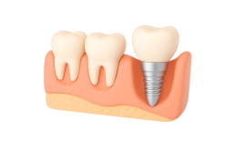 Реконструкция альвеолярного отростка