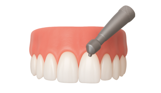 Лечение гингивита
