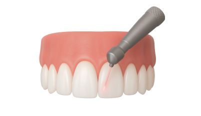 Лечение гингивита