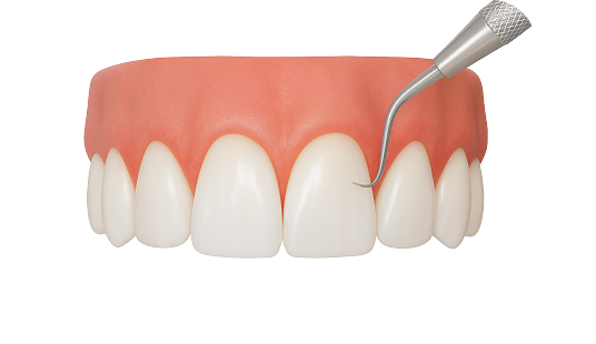 Лечение гингивита