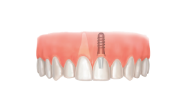 Реконструкция альвеолярного отростка