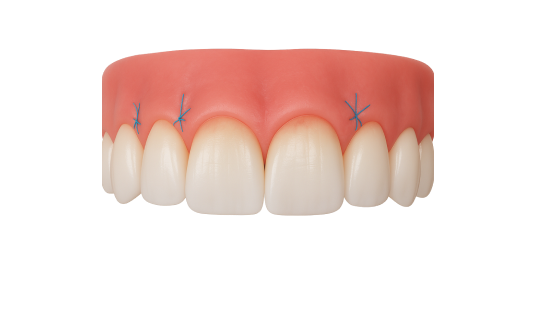 Лечение гингивита