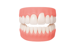 Композитная реставрация зубов