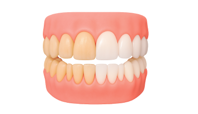 Композитная реставрация зубов