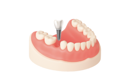 Реконструкция альвеолярного отростка