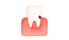 Лечение пришеечного кариеса