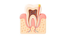 Лечение пришеечного кариеса