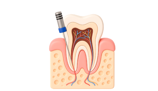 Лечение пришеечного кариеса