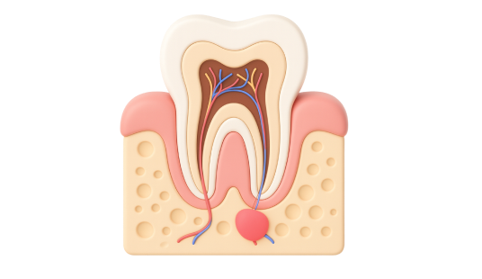 Лечение пришеечного кариеса