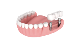 Реконструкция альвеолярного отростка