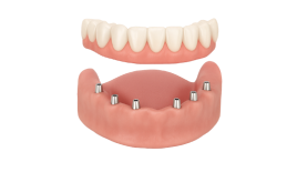 Реконструкция альвеолярного отростка