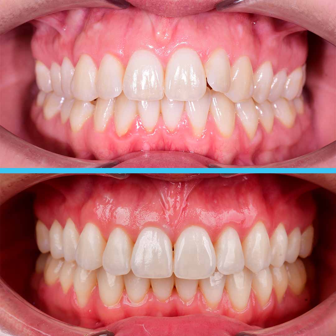 Исправление скученности на элайнерах