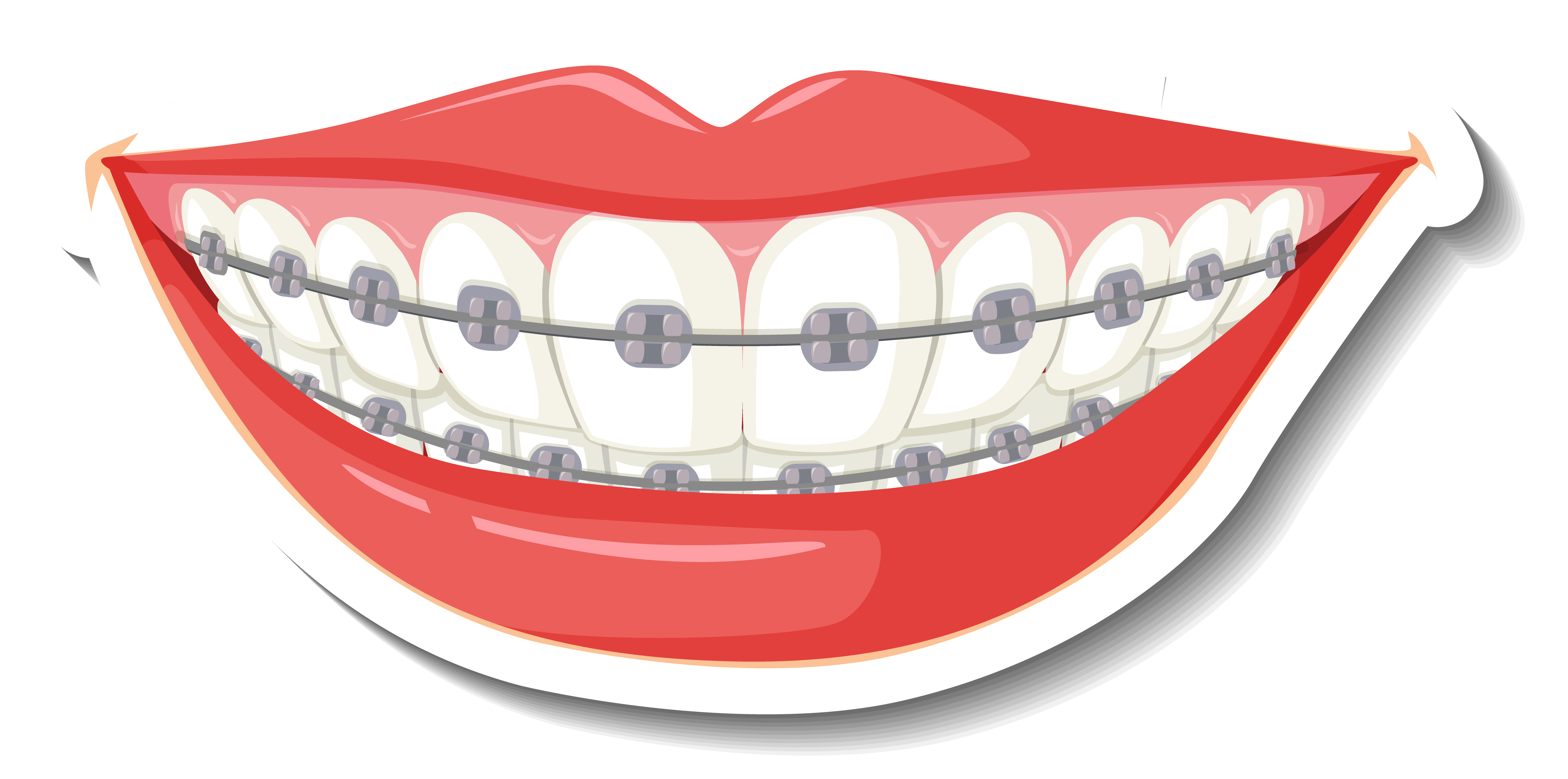 Можно ли ставить брекеты во время беременности?
